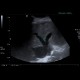 Venous congestion of liver: US - Ultrasound